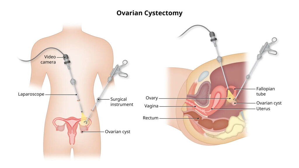 Laparoscopic Ovarian Cystectomy