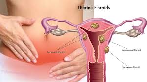 Laparoscopic Myomectomy